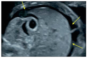 Comment conduire l’examen échographique devant la découverte d’une image liquidienne dans la cavité abdominale fœtale ?