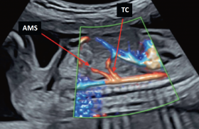 La vascularisation abdominale fœtale et ses anomalies
