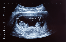 Quelles sont les nouveautés dans le suivi des grossesses gémellaires ?