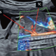 La vascularisation abdominale fœtale et ses anomalies