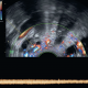 Dilatations veineuses pelviennes