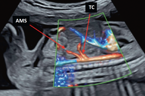 La vascularisation abdominale fœtale et ses anomalies