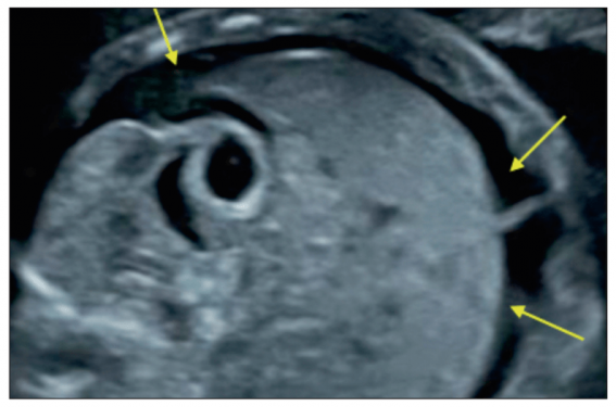 Comment conduire l’examen échographique devant la découverte d’une image liquidienne dans la cavité abdominale fœtale ?