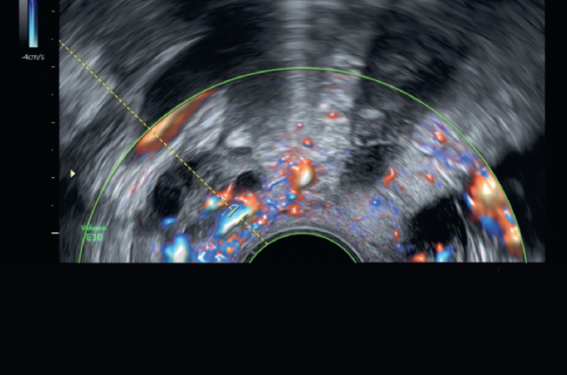 Dilatations veineuses pelviennes