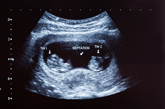 Quelles sont les nouveautés dans le suivi des grossesses gémellaires ?