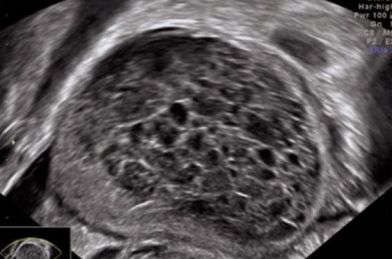 Masses ovariennes découvertes à l'échographie du 1er trimestre ...
