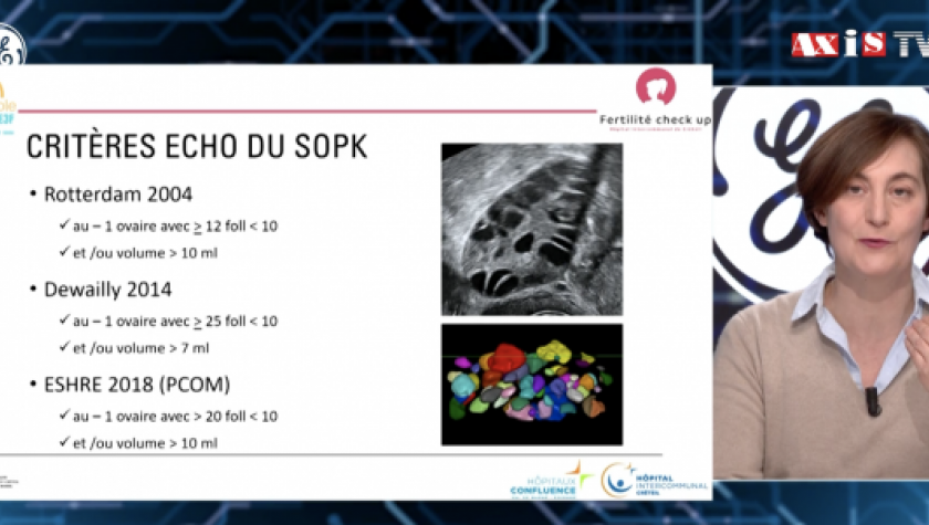 Le syndrome des ovaires polykystiques : un diagnostic échographique ?